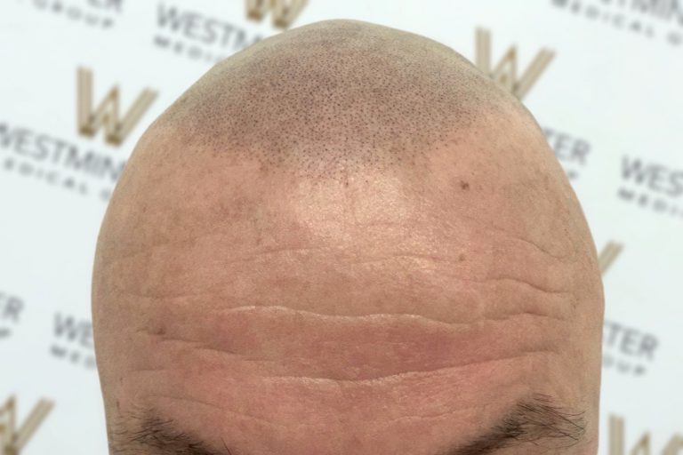 Close-up of a bald head showing detail of hair implant regions, skin texture, and slight forehead wrinkles, against a patterned background with logos.