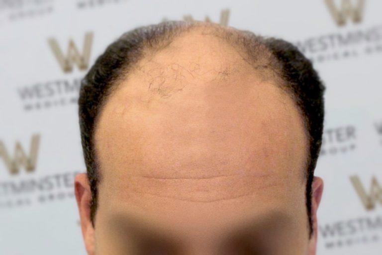 Close-up of a person's forehead showing the early stages of female hair loss, with a blurred background featuring a logo.