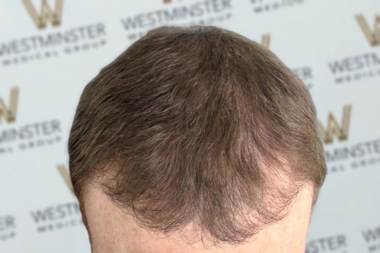 Top view of a person's head showing brown hair with signs of thinning and a receding hairline, with a backdrop featuring the "Westminster" logo repeated, indicative of female hair loss.