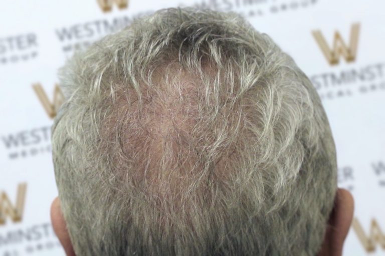 Close-up of the back of a person's head showing a bald spot with thinning grey hair, indicating female hair loss.