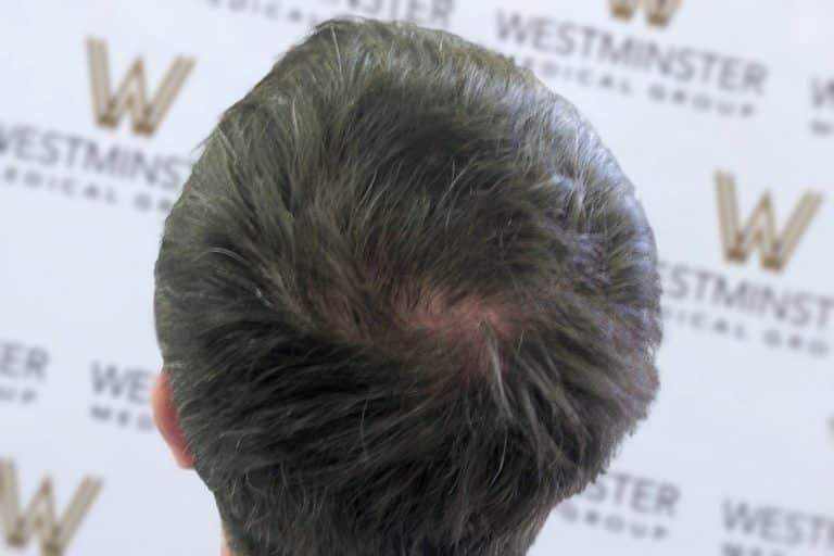 Top view of a man's head showing hair regrowth with a previously visible bald patch. The background shows a blurred banner with the Westminster logo repeated.
