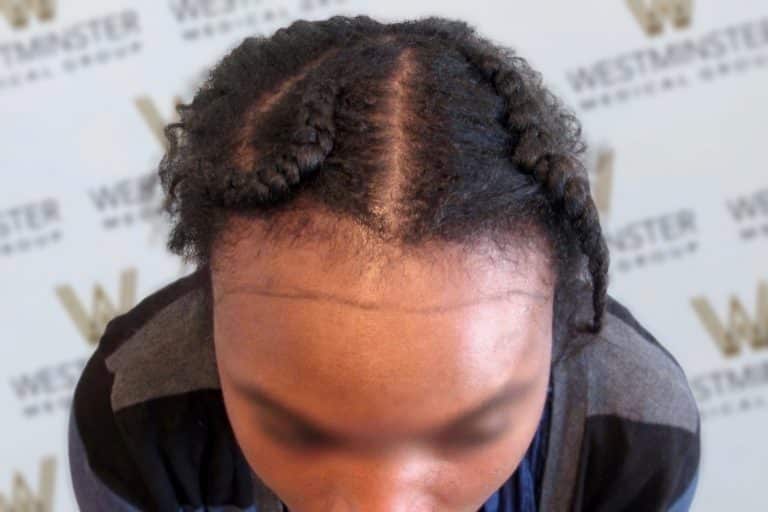 Top view of a person with intricately braided hair styled in three thick cornrows converging at the crown, addressing female hair loss. The hairstyle is showcased against a blurred background with a logo.