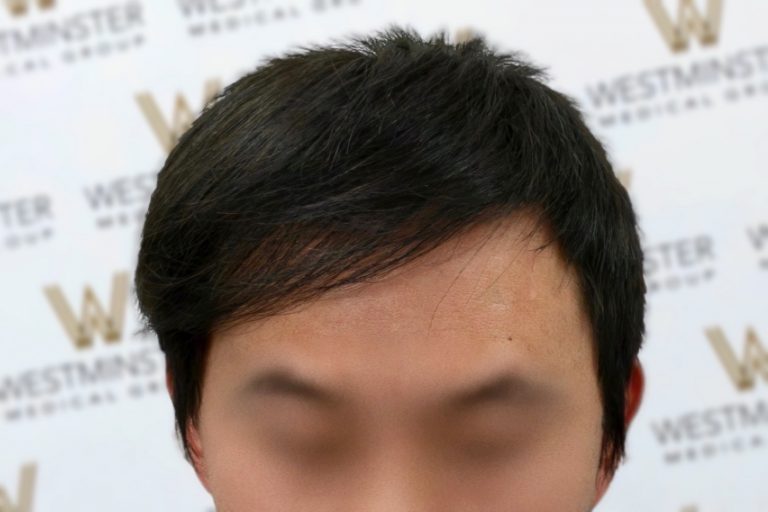 Close-up photo focused on a man's forehead and hairline demonstrating male pattern baldness, his eyes blurred out, against a backdrop with "westminster" logos.