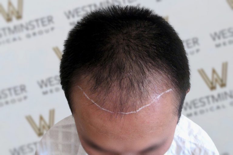 Top view of a person's head showing early stages of male pattern baldness with a visible hairline marked by a white chalk line on the scalp. Background features a logo wall with "Westminster