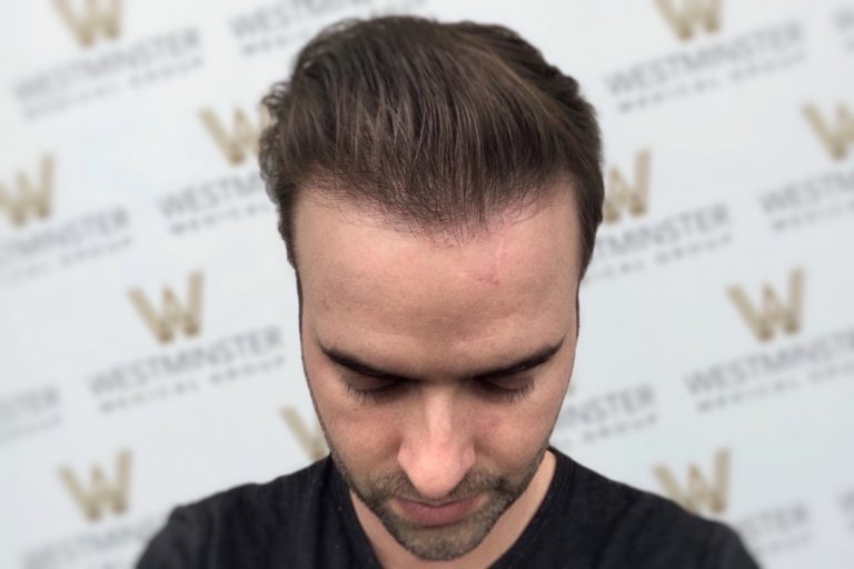 Close-up of a man's head bowed slightly, showing his combed hair after hair replacement surgery and the top part of his forehead. In the background, there is a wall with a repeating logo pattern