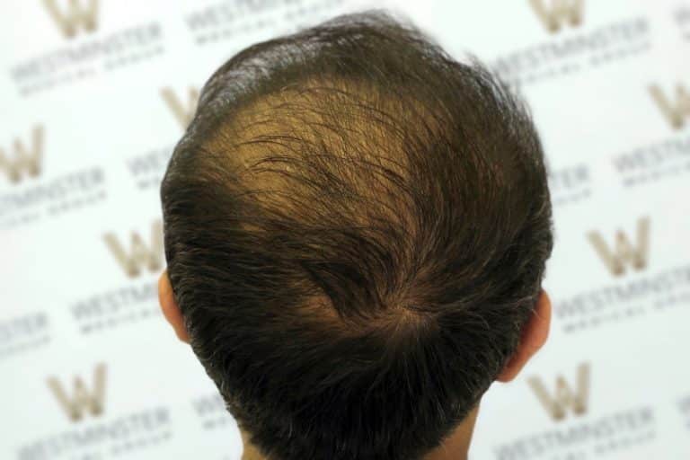 Top view of a person's head showing thinning hair and a bald spot against a background with a repeated logo pattern, indicative of female hair loss.
