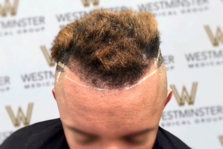 Close-up of a person's unique hairstyle featuring a high fade with a carved line design, contrasted by a voluminous top with curly light brown hair implant, against a backdrop with a logo pattern.