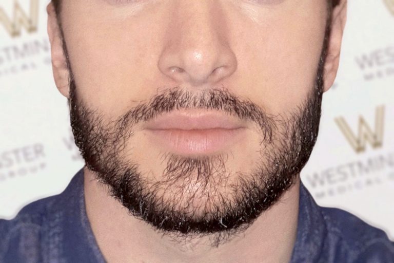 Close-up of a man's lower face showing his nose, mouth, and beard, with a blurred background featuring logos after a hair implant.