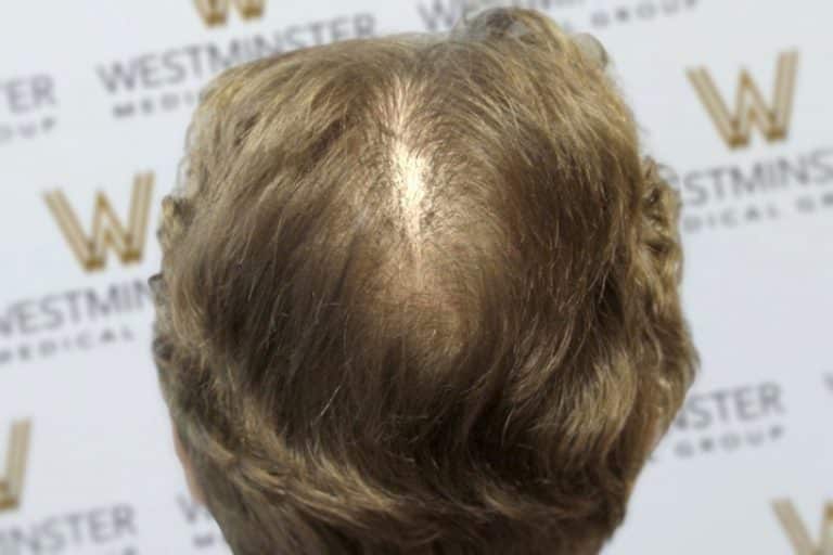 Close-up of the top of a person's head showing male pattern baldness against a backdrop with the Westminster logo.