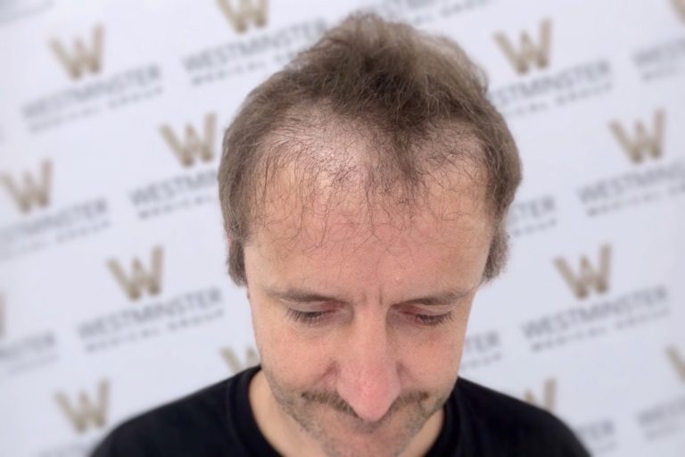 Close-up of a man's head showing male pattern baldness, focusing on the top and forehead, against a background with a repeated logo pattern.