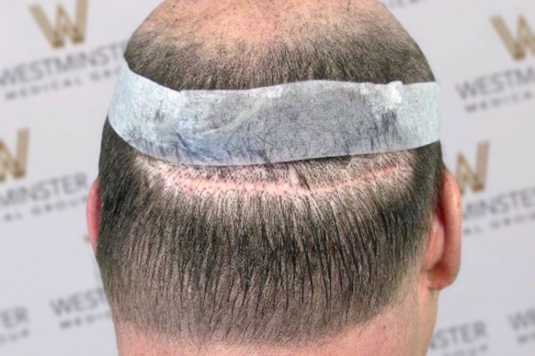 The image shows the back of a person's head post-hair implant, with visible stitches and a bandage around the head, against a backdrop with the "westminster" logo repeated.