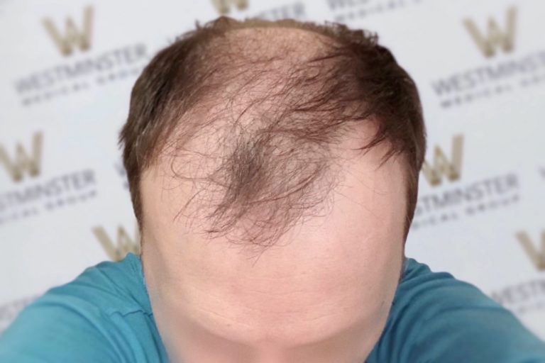 Close-up of a person's forehead showing signs of male pattern baldness, with a backdrop featuring the repeated logo of "westminster." The person is wearing a blue t-shirt.