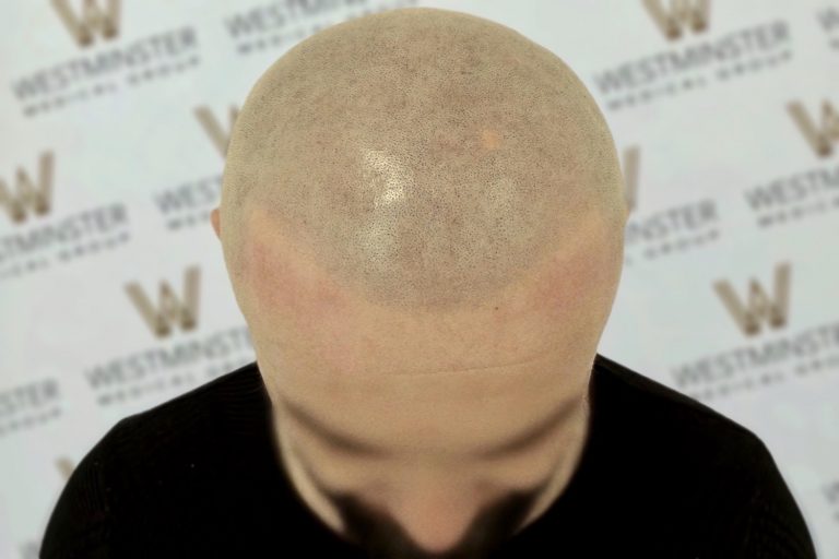 Top view of a bald head of a person experiencing female hair loss, with subtle shadow and texture, positioned against a background with repeated logo patterns.