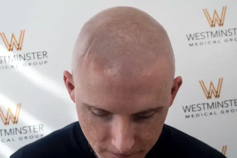 Top view of a bald man's head, showing skin texture and hair regrowth, with a background featuring the logo of Westminster Medical Group.