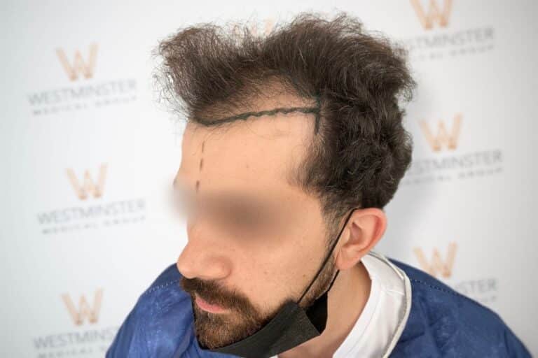 Close-up of a person with blurred facial features, showcasing distinctive curly hair despite male pattern baldness, against a backdrop with a “westminster” logo repeated.
