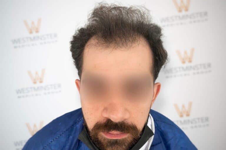 Close-up side profile of a person with curly hair against a backdrop featuring the Westminster Medical logo. The focus is on the person's hair regrowth and the clean, blurred background.