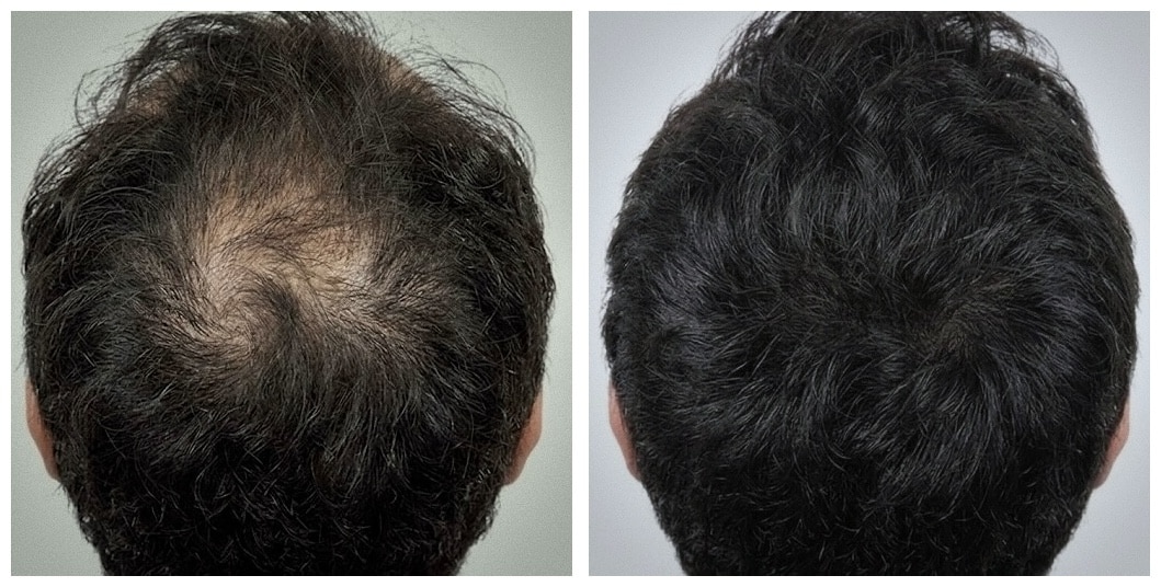 Finasteride before & after result